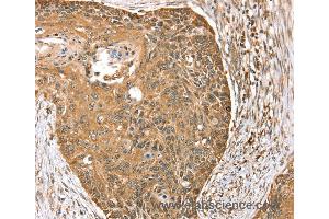 Immunohistochemistry of Human esophagus cancer using MORF4L1 Polyclonal Antibody at dilution of 1:35 (MORF4L1 anticorps)