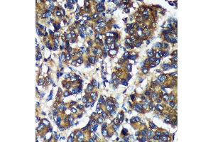 Immunohistochemistry of paraffin-embedded Human liver cancer using TMX2 Rabbit pAb (ABIN7270810) at dilution of 1:100 (40x lens).