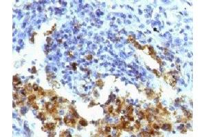 IHC testing of FFPE human lung adenocarcinoma with Napsin-A antibody (clone NPSNA-1). (NAPSA anticorps)