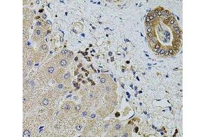 Immunohistochemistry of paraffin-embedded Human liver damage using KTN1 Polyclonal Antibody at dilution of 1:100 (40x lens). (KTN1 anticorps)