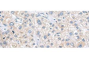 Immunohistochemistry of paraffin-embedded Human liver cancer tissue using ZNF35 Polyclonal Antibody at dilution of 1:40(x200) (ZNF35 anticorps)