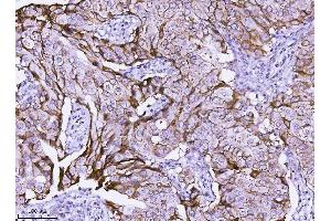 IHC analysis of ErbB 2 using anti-ErbB 2 antibody (ABIN5518830). (ErbB2/Her2 anticorps  (N-Term))