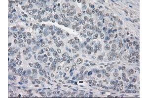 Immunohistochemical staining of paraffin-embedded Adenocarcinoma of breast tissue using anti-PPP5C mouse monoclonal antibody. (PP5 anticorps)