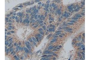 Detection of SMAD5 in Human Colorectal cancer Tissue using Polyclonal Antibody to SMAD family member 5 (SMAD5)