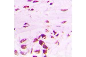 Immunohistochemical analysis of PLK1 (pT210) staining in human lung cancer formalin fixed paraffin embedded tissue section.