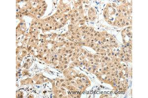 Immunohistochemistry of Human lung cancer using PAX7 Polyclonal Antibody at dilution of 1:35 (PAX7 anticorps)
