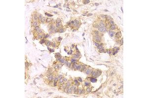 Immunohistochemistry of paraffin-embedded Human mammary cancer using CTNND1 antibody at dilution of 1:100 (x400 lens). (CTNND1 anticorps  (AA 573-832))