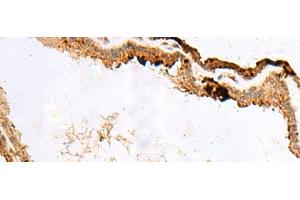Immunohistochemistry of paraffin-embedded Human thyroid cancer tissue using RABGGTA Polyclonal Antibody at dilution of 1:50(x200)