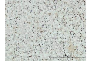 Immunoperoxidase of monoclonal antibody to AR on formalin-fixed paraffin-embedded human renal cell carcinoma tissue.