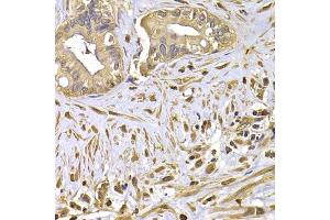 Immunohistochemistry of paraffin-embedded human liver cancer using FSCN1 antibody. (Fascin anticorps)