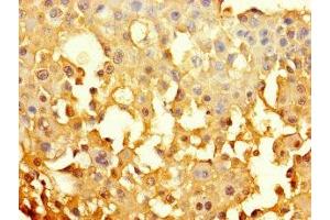 Immunohistochemistry of paraffin-embedded human breast cancer using ABIN7153625 at dilution of 1:100 (GJB6 anticorps  (AA 216-261))