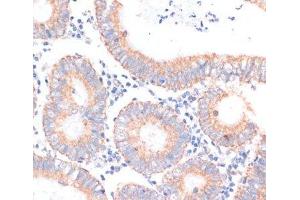 Immunohistochemistry of paraffin-embedded Human colon carcinoma using EIF4EBP1 Polyclonal Antibody at dilution of 1:100 (40x lens). (eIF4EBP1 anticorps)