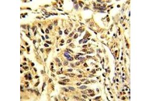 IHC analysis of FFPE human lung carcinoma stained with CEBPB antibody (CEBPB anticorps  (AA 271-298))