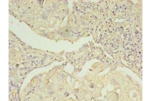 Immunohistochemistry of paraffin-embedded human lung cancer using ABIN7142288 at dilution of 1:100