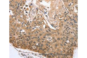 Immunohistochemistry of Human liver cancer using RBM38 Polyclonal Antibody at dilution of 1:45 (RBM38 anticorps)