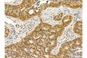 DDX39B Mouse Monoclonal Antibody at 1/100 staining human lung cancer and adjacent non-tumor tissue by IHC-P.