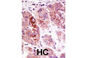 Formalin-fixed and paraffin-embedded human hepatocellular carcinoma tissue reacted with the USP7 polyclonal antibody  , which was peroxidase-conjugated to the secondary antibody, followed by AEC staining . (USP7 anticorps  (C-Term))