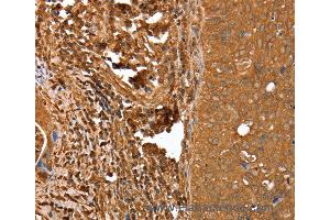 Immunohistochemistry of Human cervical cancer using CNN3 Polyclonal Antibody at dilution of 1:25 (CNN3 anticorps)