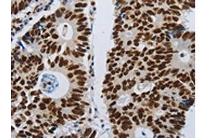 The image on the left is immunohistochemistry of paraffin-embedded Human colon cancer tissue using ABIN7192399(SLC16A14 Antibody) at dilution 1/80, on the right is treated with synthetic peptide.