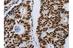 The image on the left is immunohistochemistry of paraffin-embedded Human colon cancer tissue using ABIN7192399(SLC16A14 Antibody) at dilution 1/80, on the right is treated with synthetic peptide. (SLC16A14 anticorps)