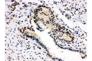 Anti- SMN1/2 Picoband antibody,IHC(P) IHC(P): Human Mammary Cancer Tissue