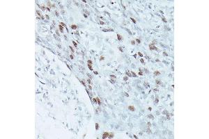 Immunohistochemistry of paraffin-embedded human breast cancer using MEF2C antibody (ABIN3023393, ABIN3023394, ABIN3023395 and ABIN6219695) at dilution of 1:100 (40x lens). (MEF2C anticorps  (AA 170-380))
