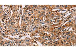 Immunohistochemistry of paraffin-embedded Human lung cancer using ACTA1 Polyclonal Antibody at dilution of 1:65 (Actin anticorps)