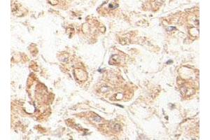 Immunohistochemical staining of formalin-fixed paraffin-embedded human fetal liver tissue showing cytoplasmic staining with ACAA1 polyclonal antibody  at 1 : 100 dilution. (ACAA1 anticorps  (AA 210-424))