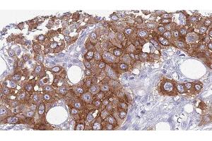 ABIN6275769 at 1/100 staining Human Head and neck cancer tissue by IHC-P. (IL11RA anticorps  (C-Term))