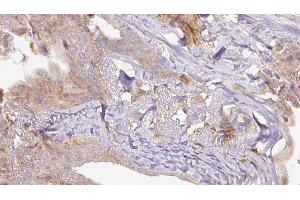 ABIN6273305 at 1/100 staining Human thyroid cancer tissue by IHC-P. (RAB3A anticorps  (N-Term))