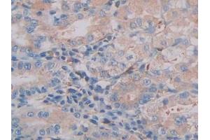 IHC-P analysis of Human Stomach cancer Tissue, with DAB staining. (CTSC anticorps  (AA 231-463))
