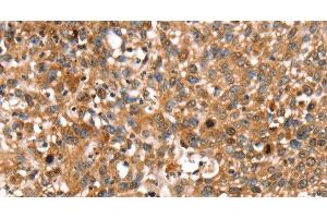 Immunohistochemistry of paraffin-embedded Human lung cancer using STAR Polyclonal Antibody at dilution of 1:35 (STAR anticorps)