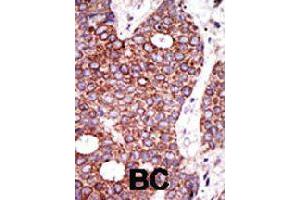 Formalin-fixed and paraffin-embedded human cancer tissue reacted with GCNT1 polyclonal antibody  , which was peroxidase-conjugated to the secondary antibody, followed by DAB staining . (GCNT1 anticorps  (C-Term))