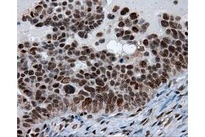 Immunohistochemical staining of paraffin-embedded Adenocarcinoma of breast tissue using anti-SIL1 mouse monoclonal antibody. (SIL1 anticorps)