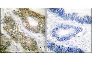Immunohistochemistry analysis of paraffin-embedded human colon carcinoma tissue, using SEPARASE (Ab-801) Antibody. (Separase anticorps  (AA 767-816))