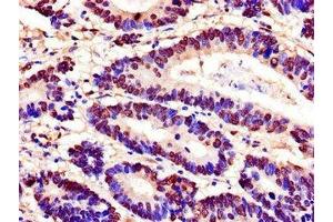 Immunohistochemistry of paraffin-embedded human colon cancer using ABIN7168587 at dilution of 1:100 (SPDEF/PSE anticorps  (AA 145-247))