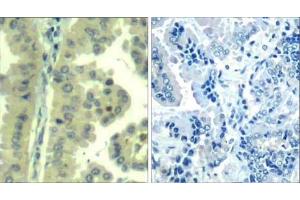Immunohistochemical analysis of paraffin-embedded human lung carcinoma tissue using eIF4G (Ab-1232) Antibody (E021514). (EIF4G1 anticorps)