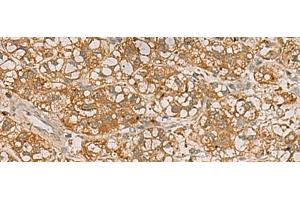 Immunohistochemistry of paraffin-embedded Human liver cancer tissue using QDPR Polyclonal Antibody at dilution of 1:70(x200) (QDPR anticorps)