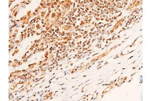 ABIN6267221 at 1/100 staining human Cholangio-carcinoma tissue sections by IHC-P.