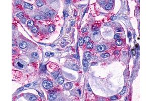 Anti-TAAR9 antibody IHC of human Lung, Adenocarcinoma.