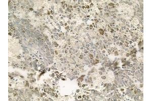 ABIN6256978 and ABIN6273749 at 1/100 staining human melanoma by IHC-P. (C9orf156 anticorps  (Internal Region))
