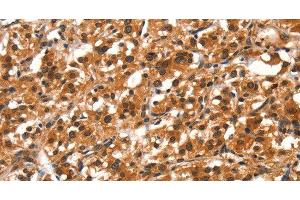 Immunohistochemistry of paraffin-embedded Human thyroid cancer tissue using DDX4 Polyclonal Antibody at dilution 1:40