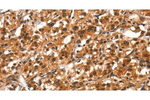 Immunohistochemistry of paraffin-embedded Human thyroid cancer tissue using DDX4 Polyclonal Antibody at dilution 1:40 (DDX4 anticorps)