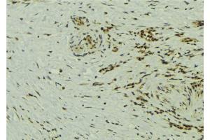 ABIN6273240 at 1/100 staining Human breast cancer tissue by IHC-P. (ETV5 anticorps  (Internal Region))