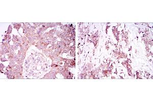 Immunohistochemical analysis of paraffin-embedded ovarian cancer tissues (left) and lung cancer tissues (right) using ATXN1 mouse mAb with DAB staining. (Ataxin 1 anticorps)