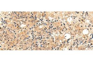Immunohistochemistry of paraffin-embedded Human esophagus cancer tissue using ZFYVE27 Polyclonal Antibody at dilution of 1:50(x200) (ZFYVE27 anticorps)