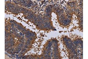The image on the left is immunohistochemistry of paraffin-embedded Human colon cancer tissue using ABIN7130206(MCTS1 Antibody) at dilution 1/30, on the right is treated with fusion protein. (MCTS1 anticorps)