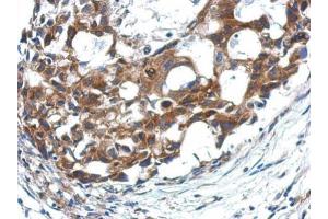 IHC-P Image Immunohistochemical analysis of paraffin-embedded human breast cancer, using APAF1, antibody at 1:500 dilution.