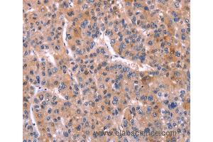 Immunohistochemistry of Human liver cancer using TNFRSF17 Polyclonal Antibody at dilution of 1:30
