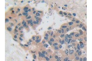 IHC-P analysis of Human Breast cancer Tissue, with DAB staining. (CSN2 anticorps  (AA 41-198))